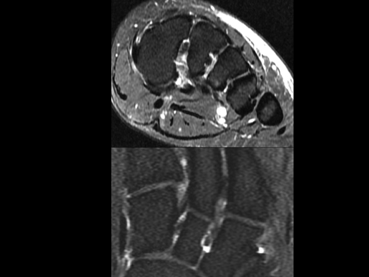 Figure 4 for case os intermetatarseum